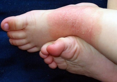 dermatitis on feet